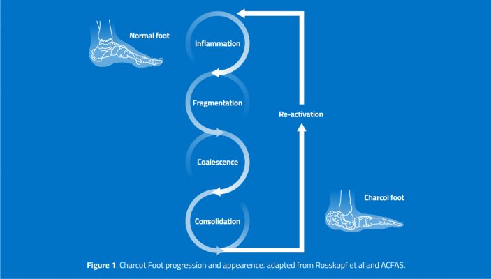 , Charcot Foot and Ankle: Definition and Classification