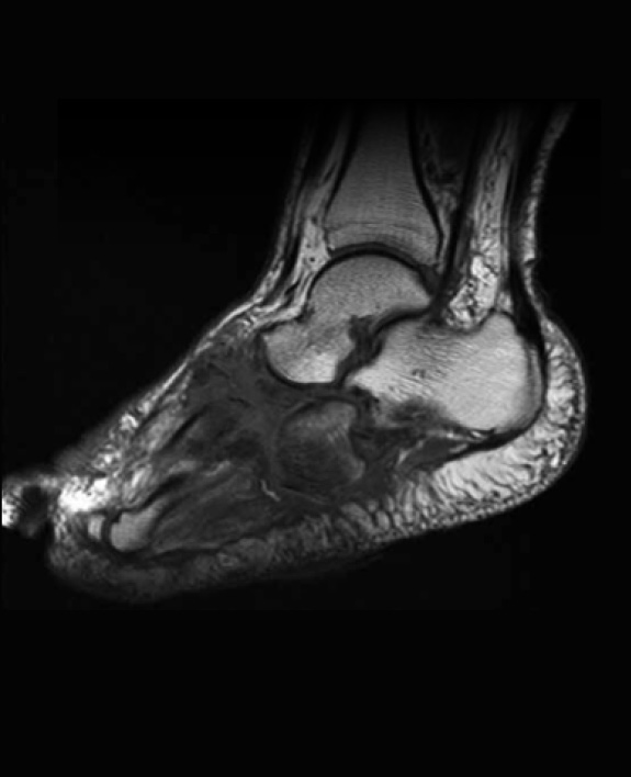 , Charcot Surgical Reconstruction