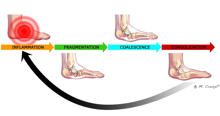 , Charcot Arthropathy Symptoms and Initial Stage