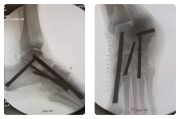 , Charcot Foot Reconstruction Using Internal Fixation